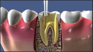 Trattamento endodontico